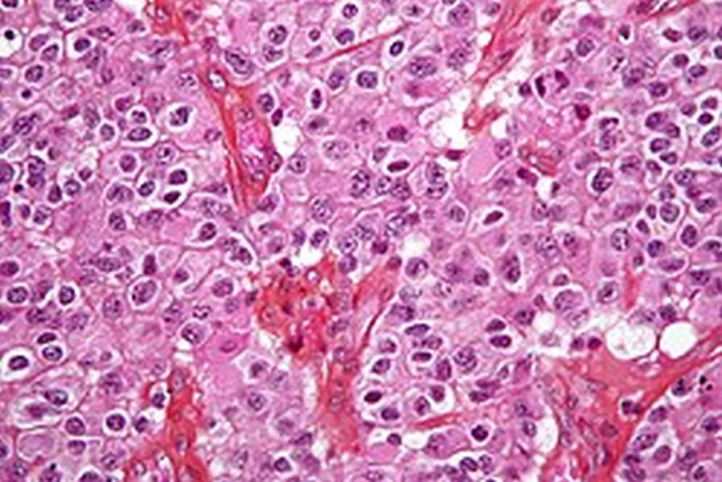 Surgeons Rescue Tumor From Brain Of Malignant Palestine Activist