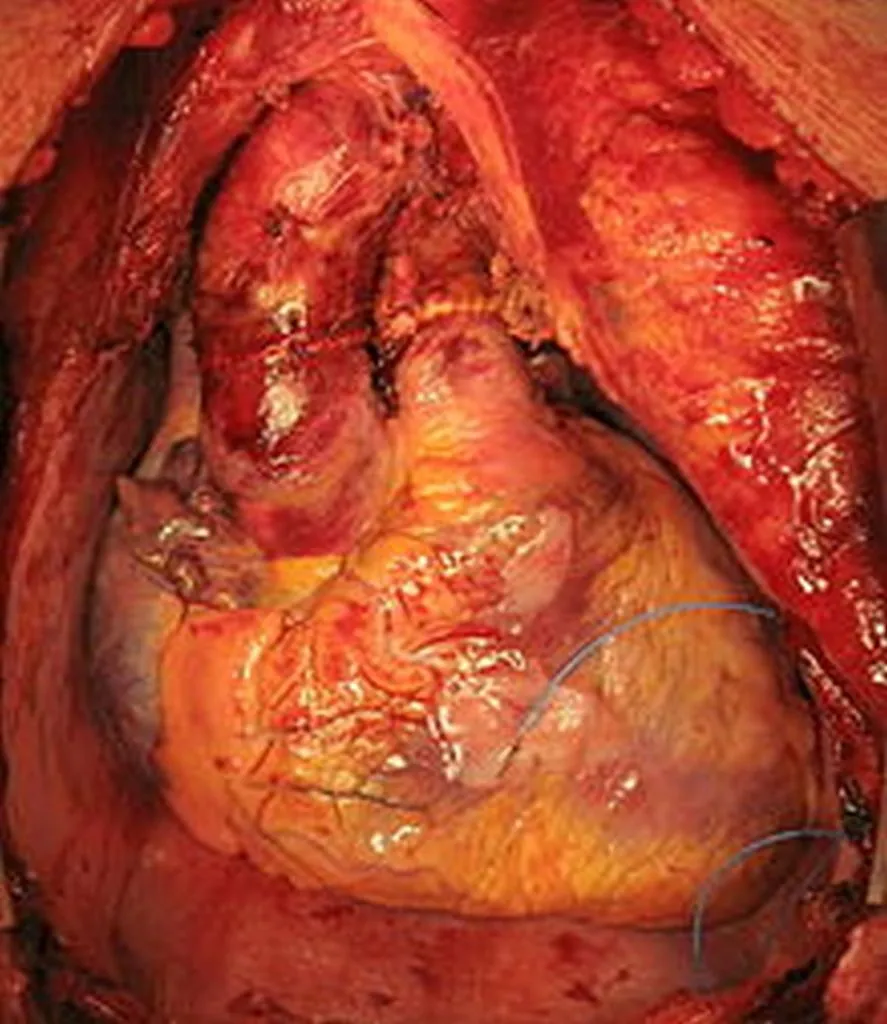 ISIS Struggling To Harvest Organs For Israel Fast Enough