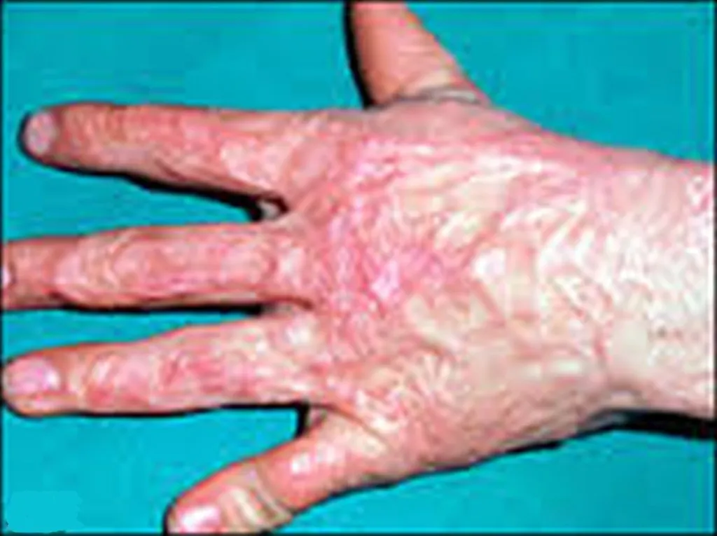 Hand That Feeds Palestinians Now Almost All Scar Tissue