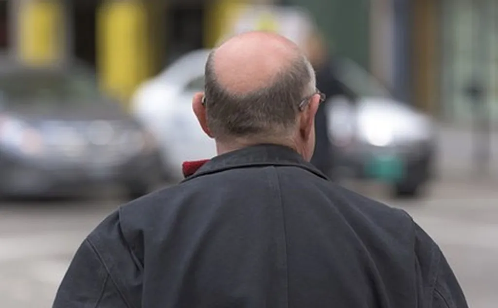 New Solar Energy Technology Uses Glare From Bald Men’s Heads