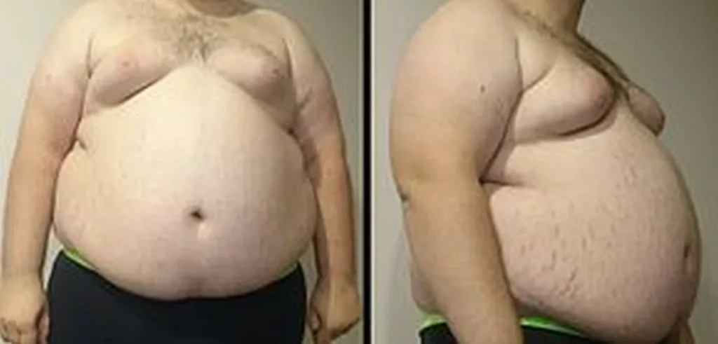 Doctors Barred From Treating Obese Man Who Identifies As Thin